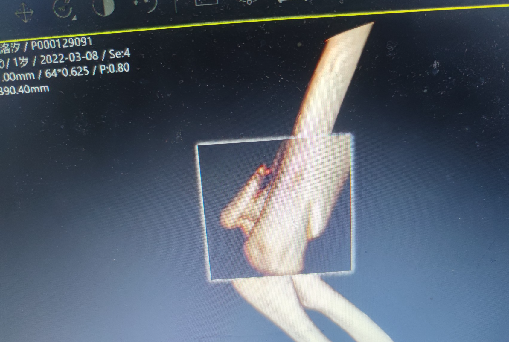 CT四肢关节重建