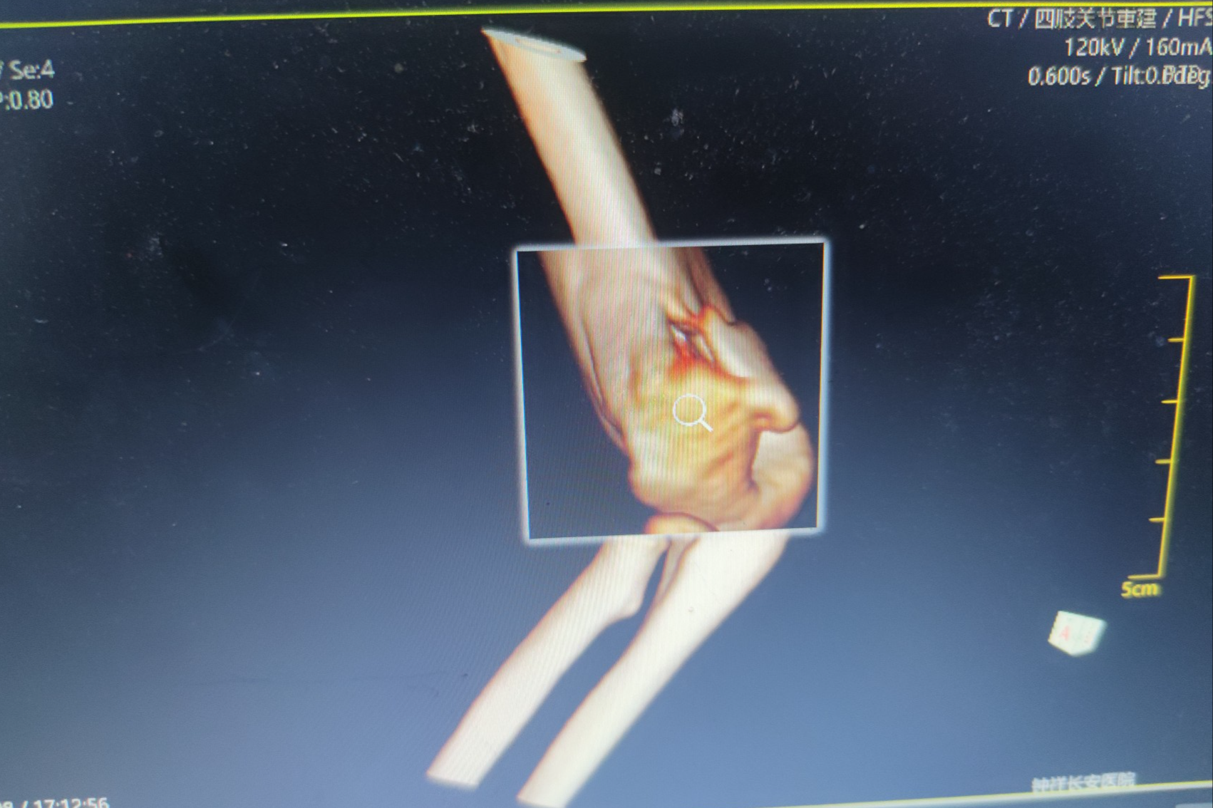 CT四肢关节重建